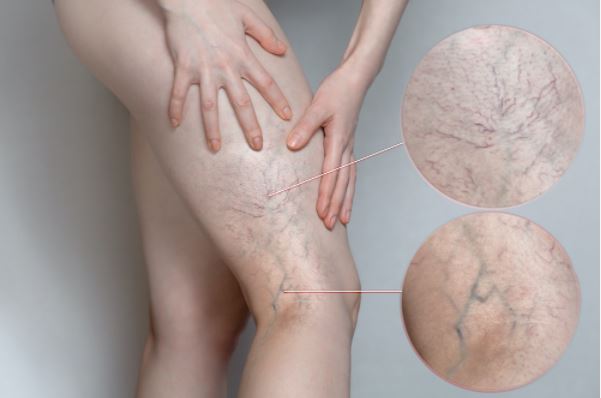 varicose veins